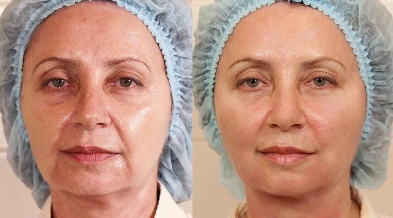 face lift before and after photos