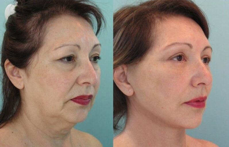 Tightening as a result of rejuvenation of the facial skin with threads