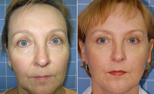 Before and after facial rejuvenation with fractional laser