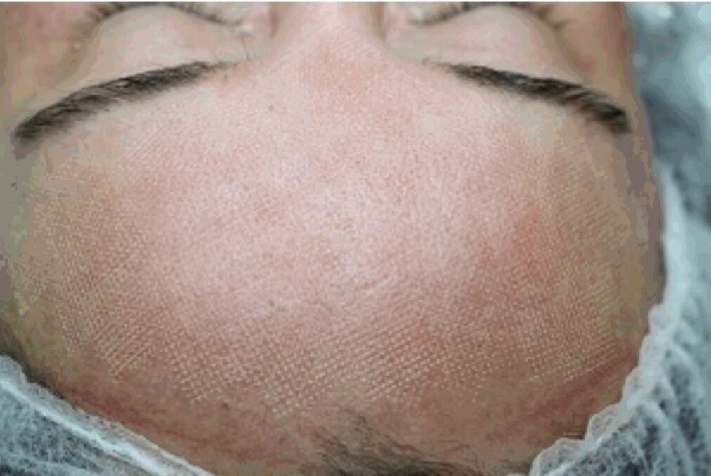 Redness and mild swelling on the skin after fractional laser
